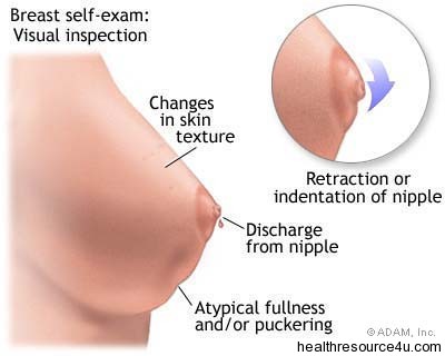 breast cancer symptoms. of Breast Cancer which are