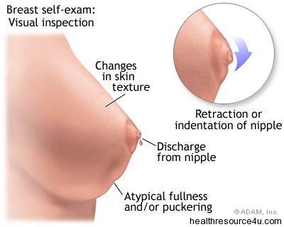 of Breast Cancer which are breast cancer symptoms. of Breast Cancer which are