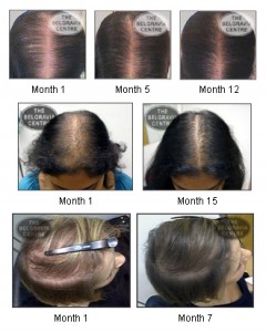 Hair loss Hair loss