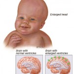hydrocephalus