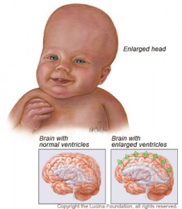hydrocephalus hydrocephalus 262x300 Hydrocephalus Symptoms, Picture, Causes, and Treatment