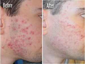 Acne Scars 