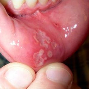 Mouth Ulcers 300x300 Mouth Ulcers   Causes, Symptoms and Treatment