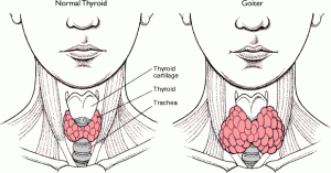 goiter pictures goiter pictures 300x157 Goiter Causes, Pictures, Symptoms And Treatment