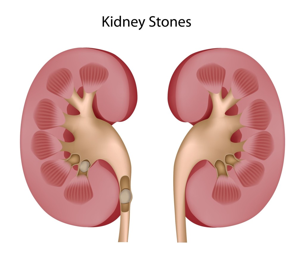 Kidney Pain - Causes, Location,Symptoms And Treatment