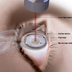 LASIK eye surgery