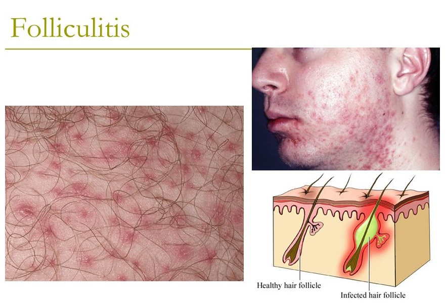 what causes folliculitis