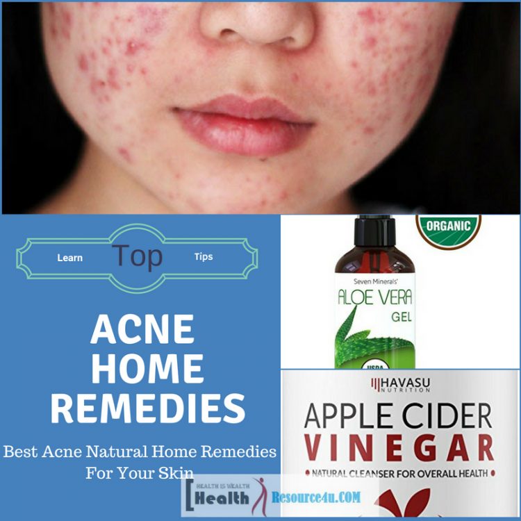 Best Acne Natural Home Remedies