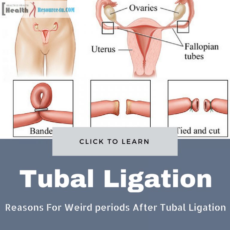 Weird periods After Tubal Ligation