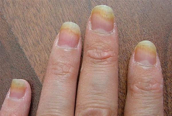 fingernails