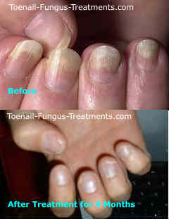 Fingernail Fungus