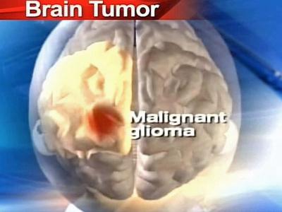 Glioma Tumor