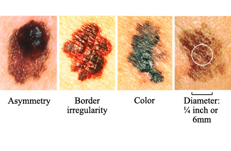 melanoma skin cancer pictures