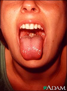 Mononucleosis Mouth