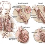 Chronic Obstructive Pulmonary Disease symptoms and treatment