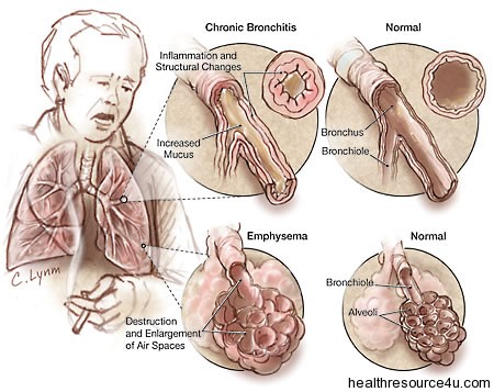 Chronic Obstructive Pulmonary Disease symptoms and treatment
