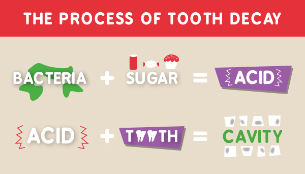Process of Tooth Decay