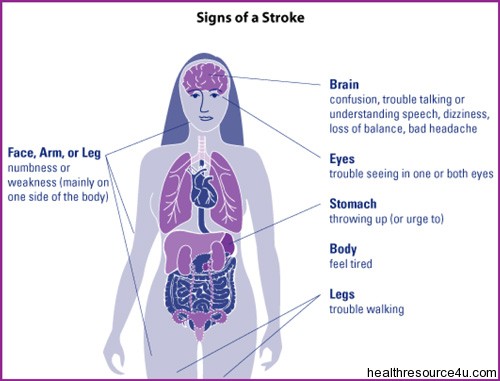 Signs Of Stroke