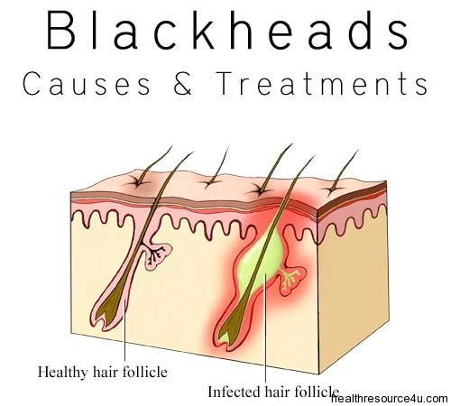 blackheads treatments causes