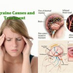 Migraine Headache: Causes, Pictures, Symptoms and Medications