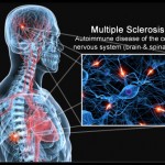 Multiple Sclerosis