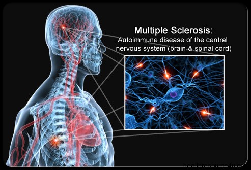 Multiple Sclerosis