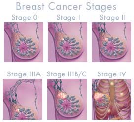 stages of breast cancer