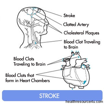 Stroke