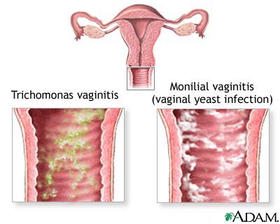 vaginal itching