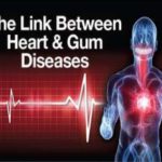 Cavity Causing Bacteria May Infect The Heart