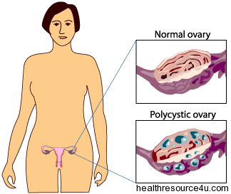 Polycystic Ovary Syndrome