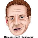 Ramsay Hunt Syndrome: Causes, Symptoms And Treatment