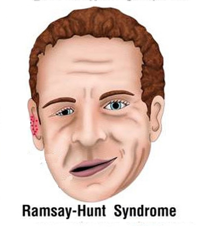 Ramsay Hunt Syndrome: Causes, Symptoms And Treatment
