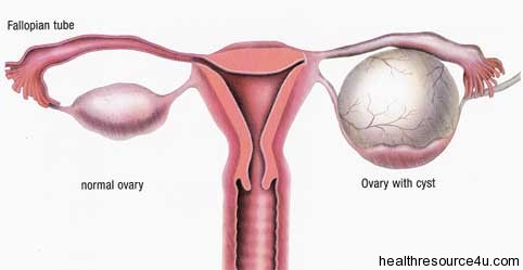 Ovarian Cyst