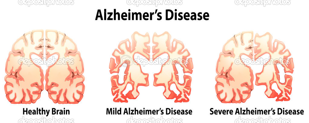 Alzheimer's Disease