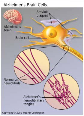 CAUSES OF ALZHEIMER DISEASE