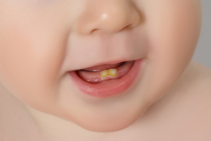 Dental Fluorosis in Babies