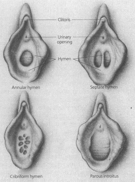 Different types of hymen