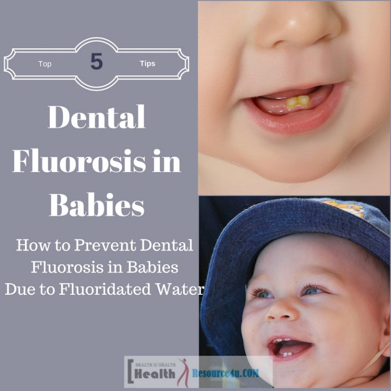 Fluoridated Water May Cause Fluorosis in Babies