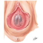 Imperforate Hymen