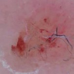 Morgellons Disease Symptoms