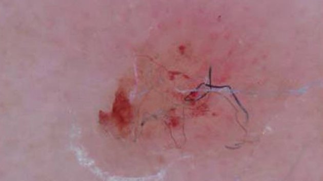 Morgellons Disease Symptoms