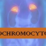 pheochromocytoma