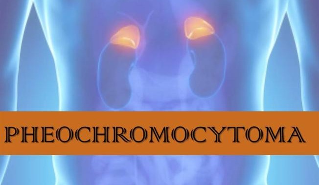 pheochromocytoma