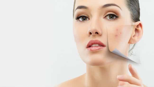 Treatment of Acne