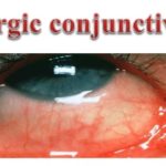 allergic conjunctivitis