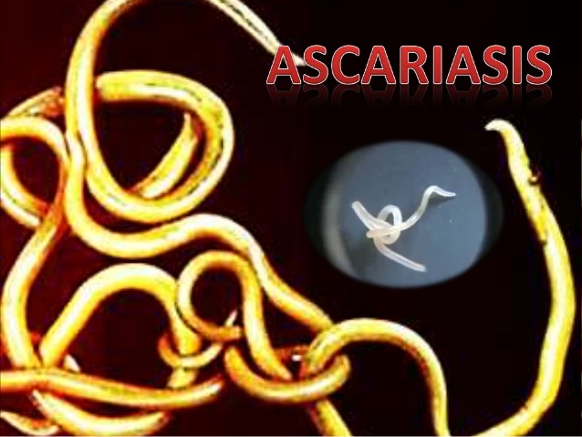 Ascariasis