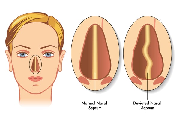 Deviated Septum