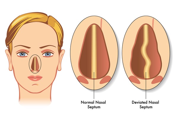 Deviated Septum