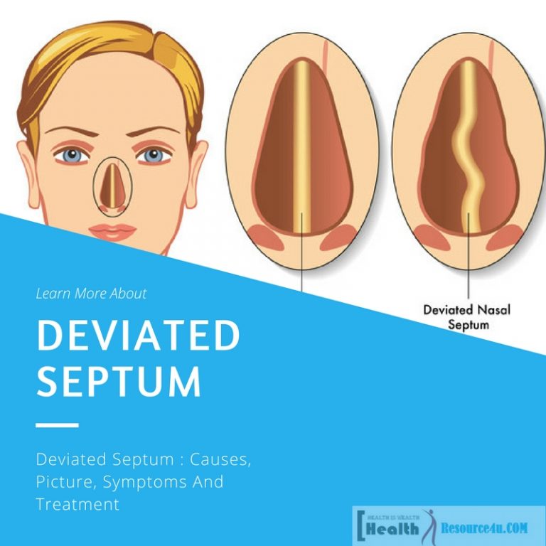 Deviated Septum1